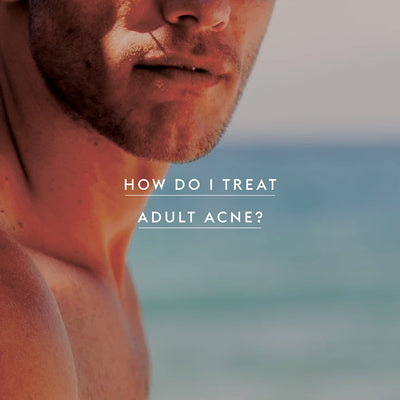 How Do I Treat Adult Acne?